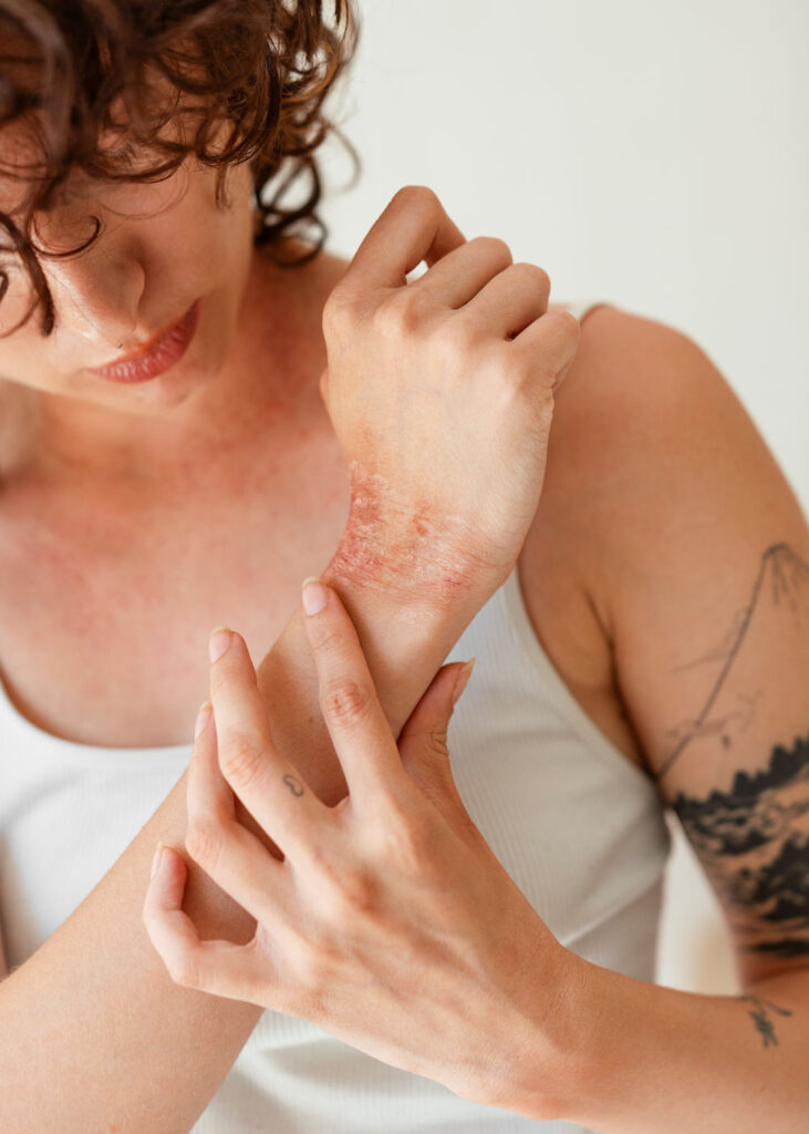 reacciones alergicas al cromo