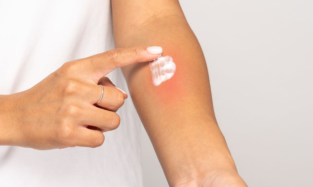 tratamiento de dermatitis alergica